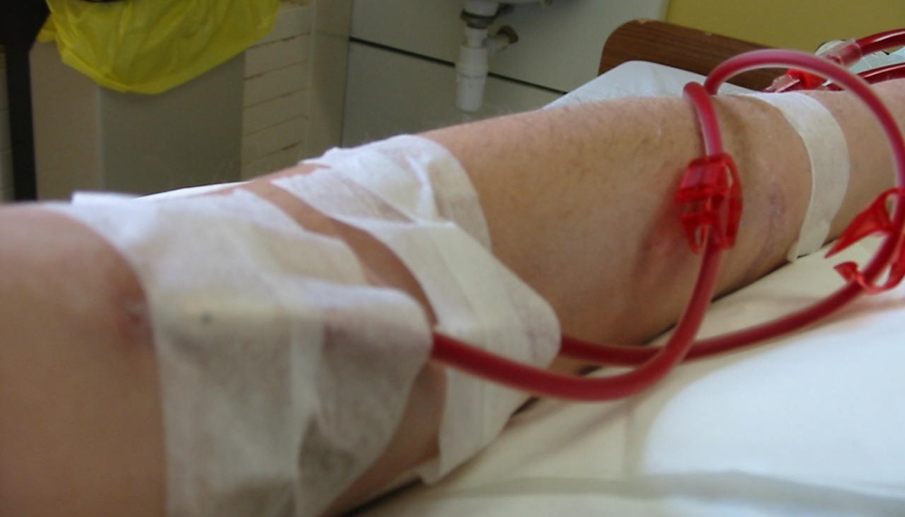 Plugged into dialysis